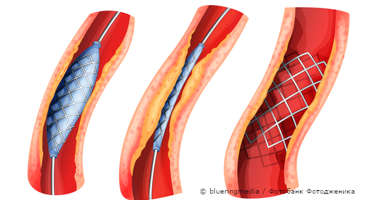 Атеросклероз сонных артерий: последствия значительны