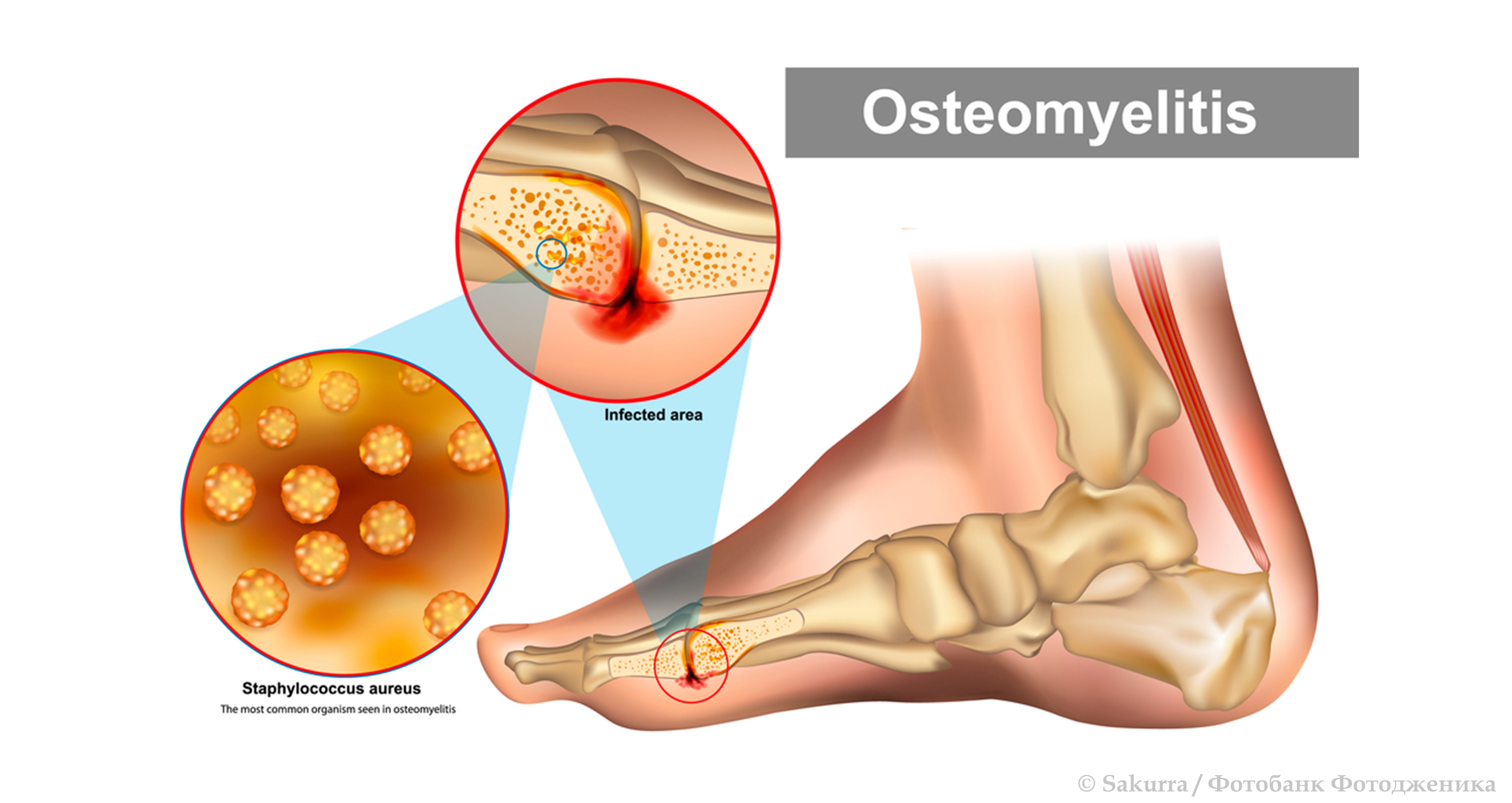 Остеомиелит: причины, симптомы, диагностика и лечение