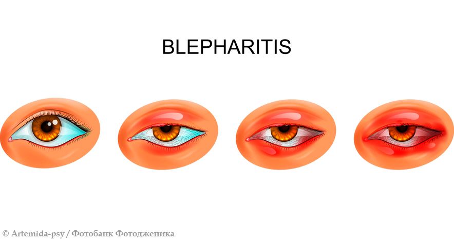 Блефарит: признаки, симптомы, диагностика и лечение