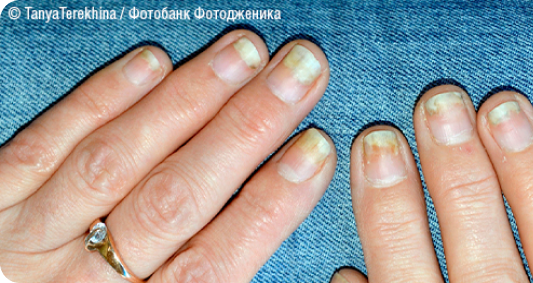 Онихолизис (отслоение ногтевой пластинки от ногтевого ложа)