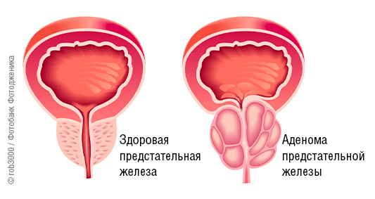 Аденома предстательной железы (доброкачественная гиперплазия предстательной железы, ДГПЖ)