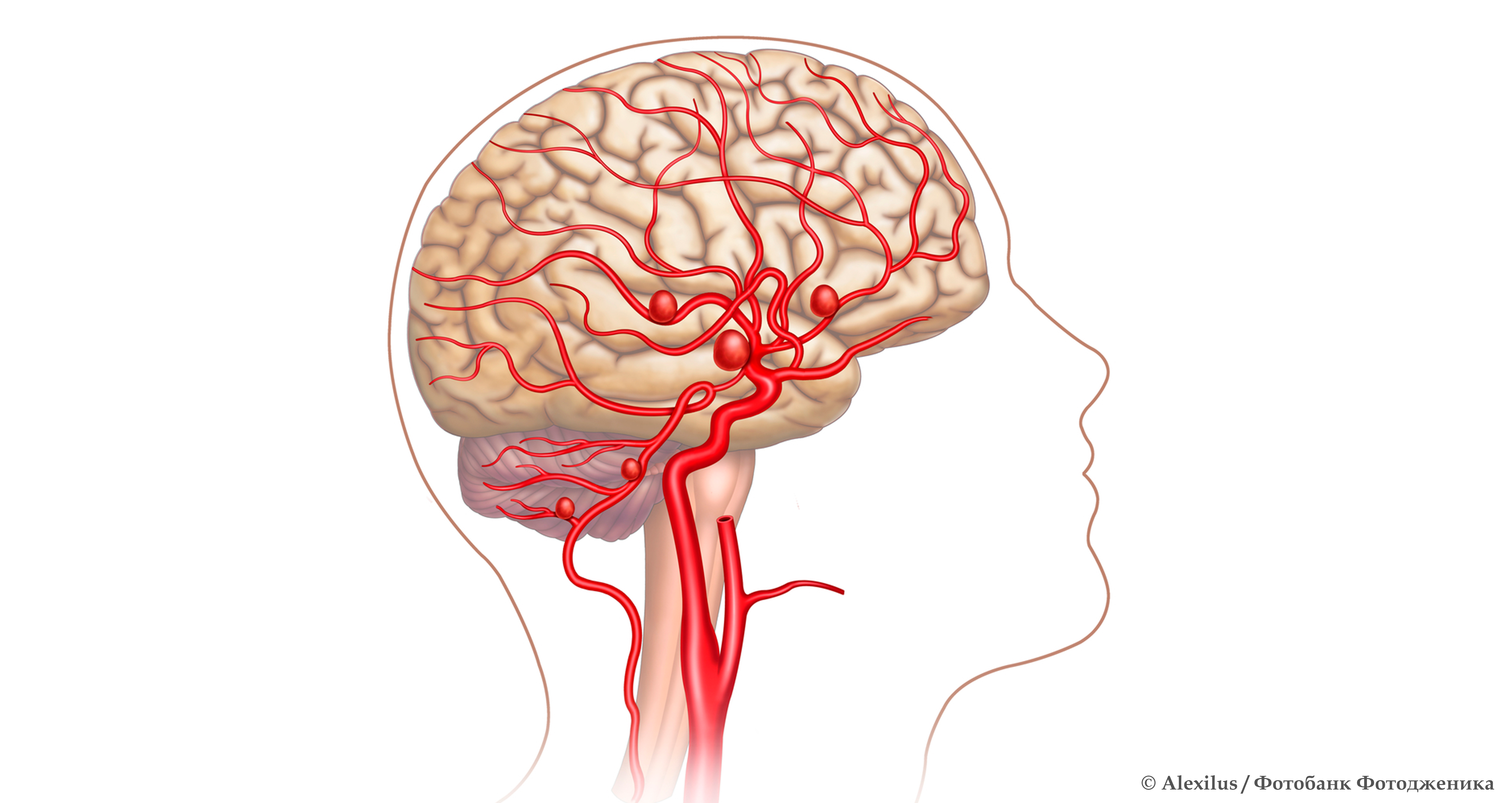 Аневризмы сосудов головного мозга: что полезно знать