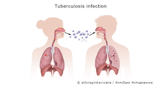 Туберкулез легких: вакцинация и настороженность